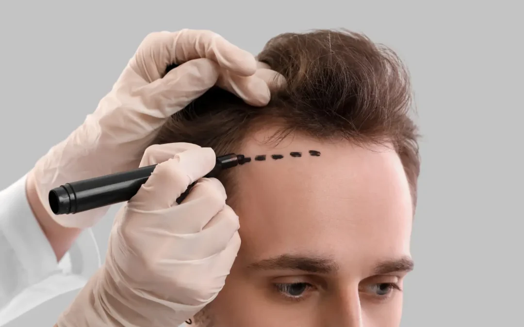 Hair Restoration Reality Check: A Personal Trainer’s Honest Assessment of Treatment Options